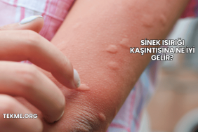 Sinek Isırığı Kaşıntısına Ne İyi Gelir?