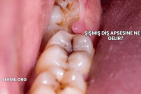 Şişmiş Diş Apsesine Ne İyi Gelir?