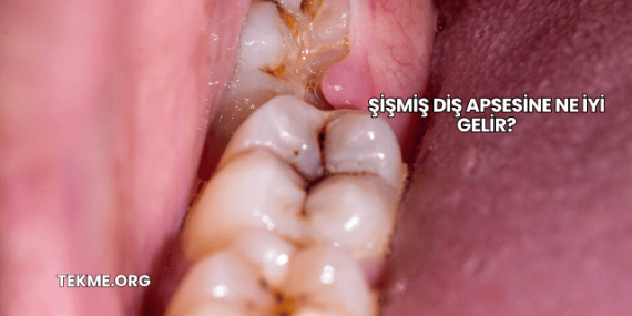 Şişmiş Diş Apsesine Ne İyi Gelir?