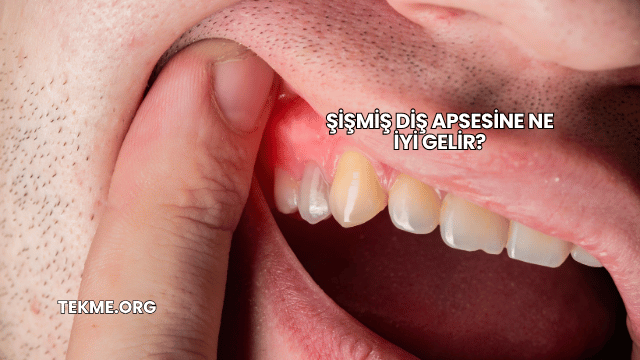 Şişmiş Diş Apsesine Ne İyi Gelir?