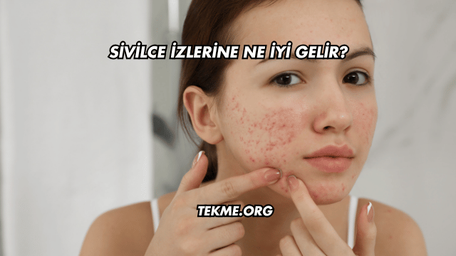 Sivilce İzlerine Ne İyi Gelir?