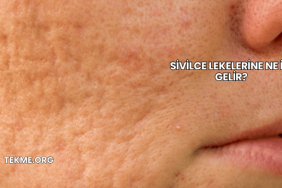 Sivilce Lekelerine Ne İyi Gelir?