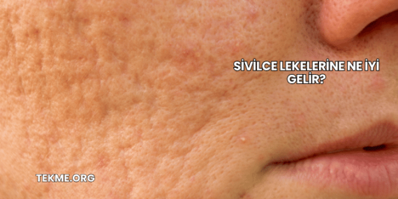 Sivilce Lekelerine Ne İyi Gelir?