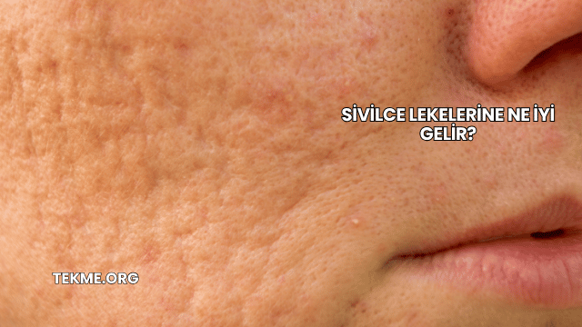 Sivilce Lekelerine Ne İyi Gelir?