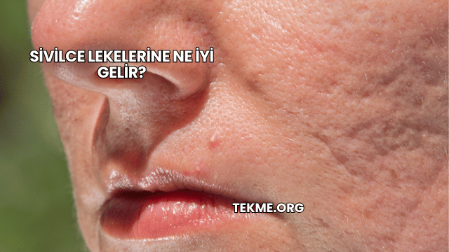 Sivilce Lekelerine Ne İyi Gelir?