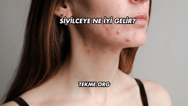 Sivilceye Ne İyi Gelir?