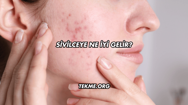 Sivilceye Ne İyi Gelir?