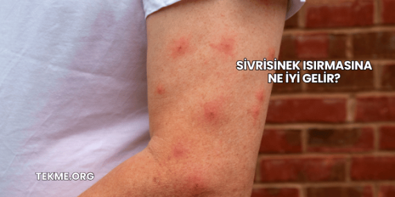 Sivrisinek Isırmasına Ne İyi Gelir?