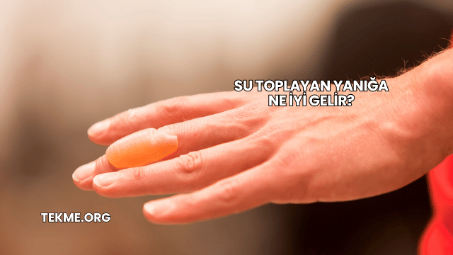 Su Toplayan Yanığa Ne İyi Gelir?