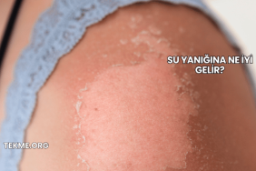 Su Yanığına Ne İyi Gelir?