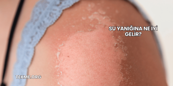 Su Yanığına Ne İyi Gelir?