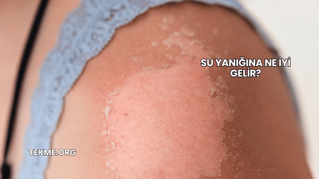 Su Yanığına Ne İyi Gelir?