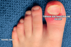 Tırnak Batmasına Ne İyi Gelir?