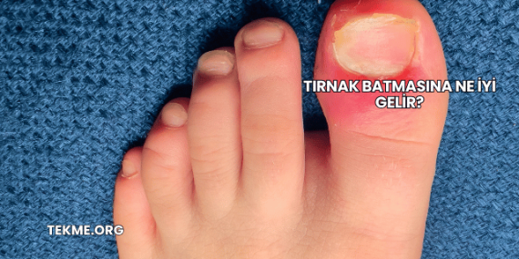 Tırnak Batmasına Ne İyi Gelir?