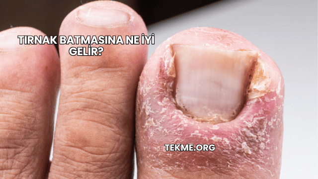 Tırnak Batmasına Ne İyi Gelir?