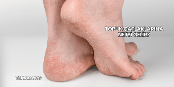 Topuk Çatlaklarına Ne İyi Gelir?