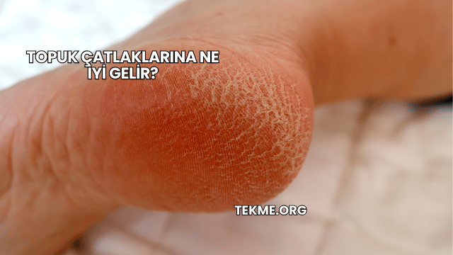 Topuk Çatlaklarına Ne İyi Gelir?