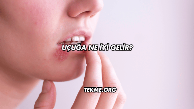 Uçuğa Ne İyi Gelir?