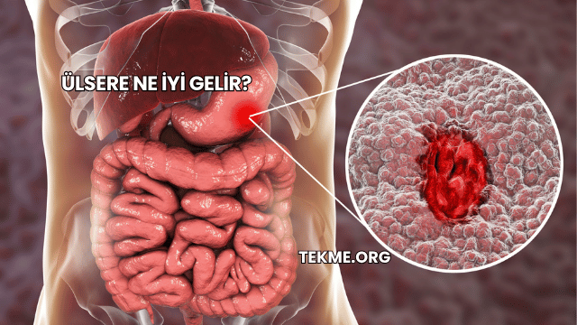 Ülsere Ne İyi Gelir?