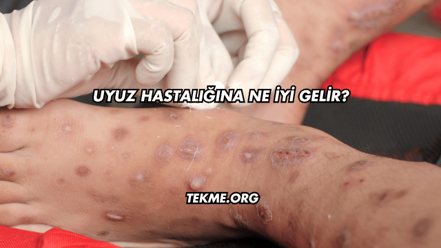 Uyuz Hastalığına Ne İyi Gelir?