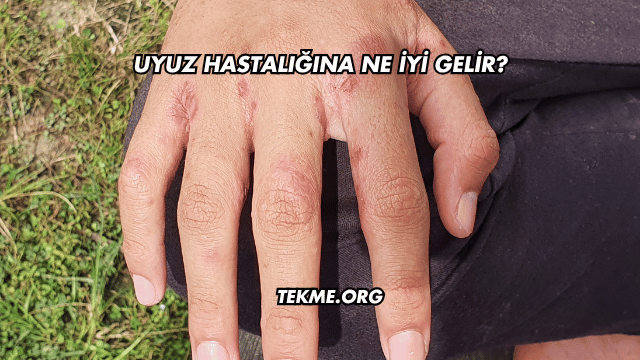 Uyuz Hastalığına Ne İyi Gelir?