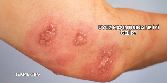 Uyuz Kaşıntısına Ne İyi Gelir?