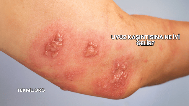 Uyuz Kaşıntısına Ne İyi Gelir?