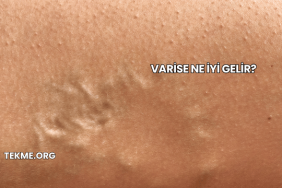 Varise Ne İyi Gelir?