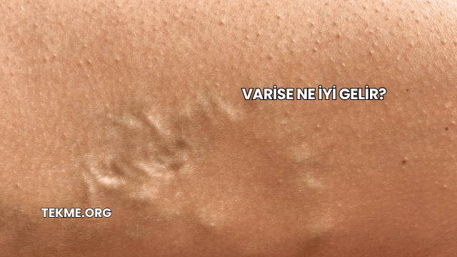 Varise Ne İyi Gelir?