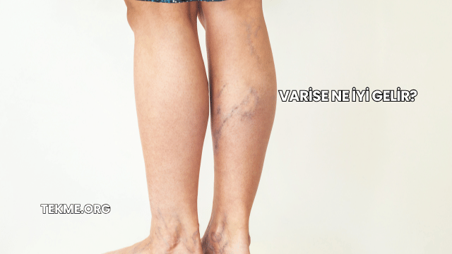 Varise Ne İyi Gelir?
