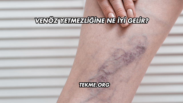 Venöz Yetmezliğine Ne İyi Gelir?
