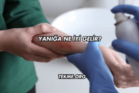 Yanığa Ne İyi Gelir?