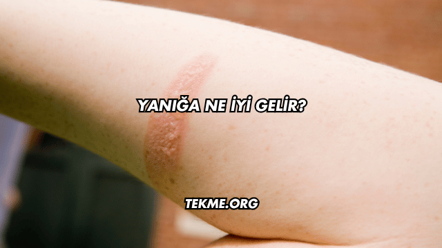 Yanığa Ne İyi Gelir?