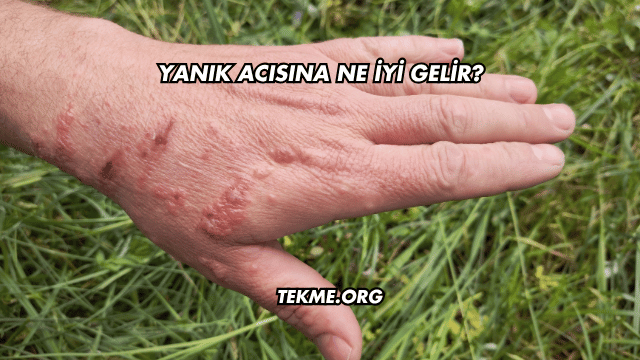Yanık Acısına Ne İyi Gelir?