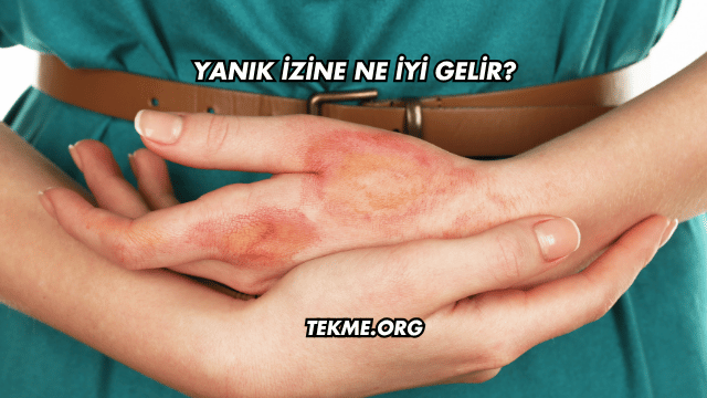 Yanık İzine Ne İyi Gelir?
