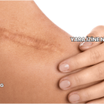 Yara İzine Ne İyi Gelir?