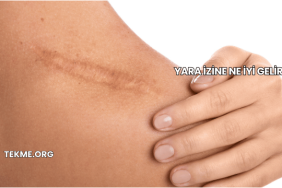Yara İzine Ne İyi Gelir?