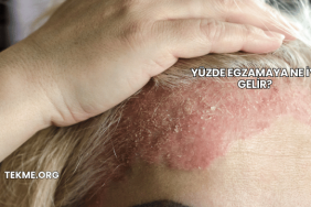 Yüzde Egzamaya Ne İyi Gelir?