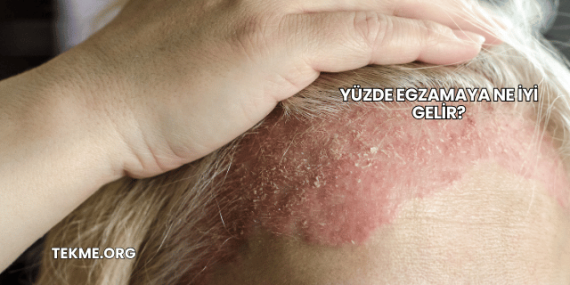 Yüzde Egzamaya Ne İyi Gelir?