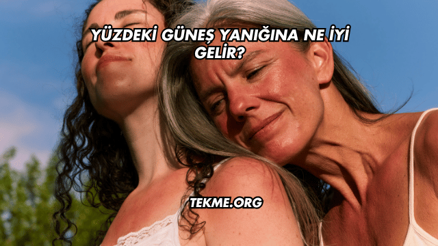 Yüzdeki Güneş Yanığına Ne İyi Gelir?