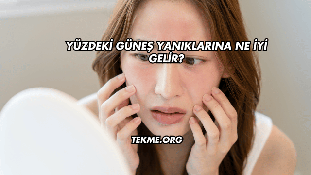 Yüzdeki Güneş Yanıklarına Ne İyi Gelir?