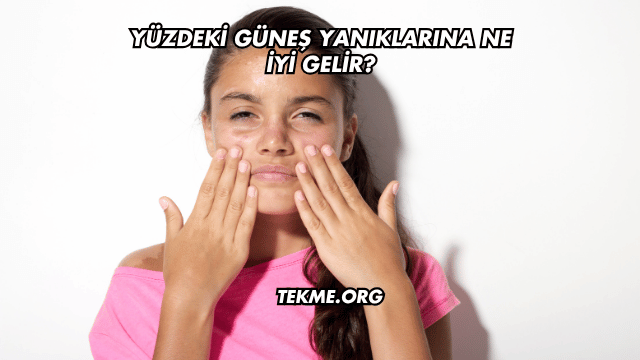 Yüzdeki Güneş Yanıklarına Ne İyi Gelir?