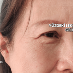 Yüzdeki Lekelere Ne İyi Gelir?