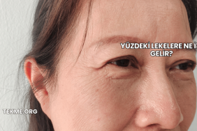 Yüzdeki Lekelere Ne İyi Gelir?