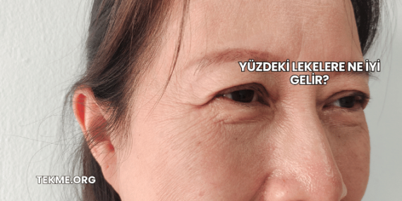 Yüzdeki Lekelere Ne İyi Gelir?