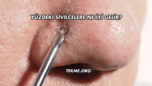 Yüzdeki Sivilcelere Ne İyi Gelir?