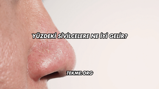 Yüzdeki Sivilcelere Ne İyi Gelir?