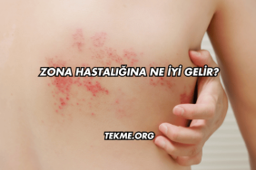 Zona Hastalığına Ne İyi Gelir?
