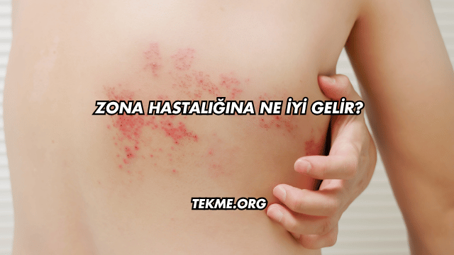Zona Hastalığına Ne İyi Gelir?