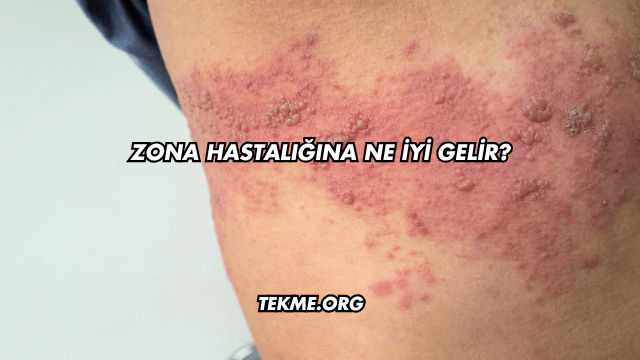 Zona Hastalığına Ne İyi Gelir?